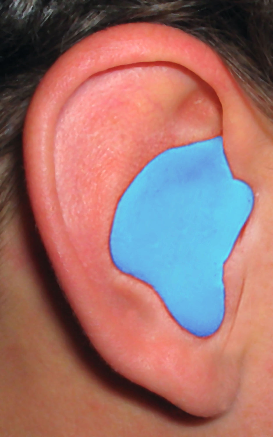 RADIANS CUSTOM MOLDED EARPLUGS